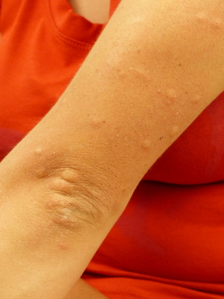 Alergia - czym jest i jak ją leczyć. Odwiedź i zapytaj alergologa