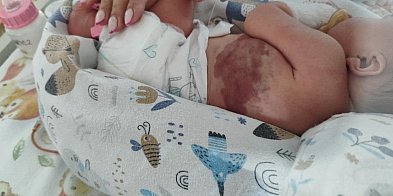 Przełomowa terapia prenatalna w gdańskim UCK-60582