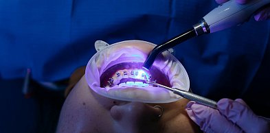 Mity dotyczące aparatów ortodontycznych - co jest prawdą, a co nie?