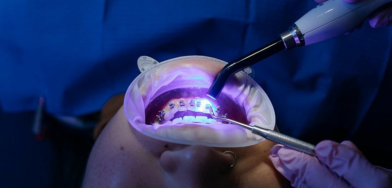 Mity dotyczące aparatów ortodontycznych - co jest prawdą, a co nie?