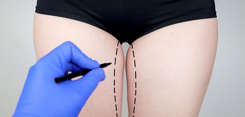 Liposukcja kolan i łydek co warto wiedzieć?